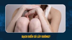 bạch biến có lây không