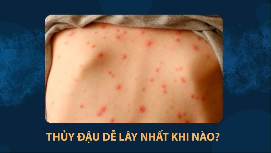thủy đậu dễ ​​lây nhất khi nào