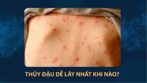thủy đậu dễ ​​lây nhất khi nào