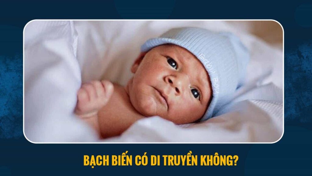 bạch biến có di truyền không