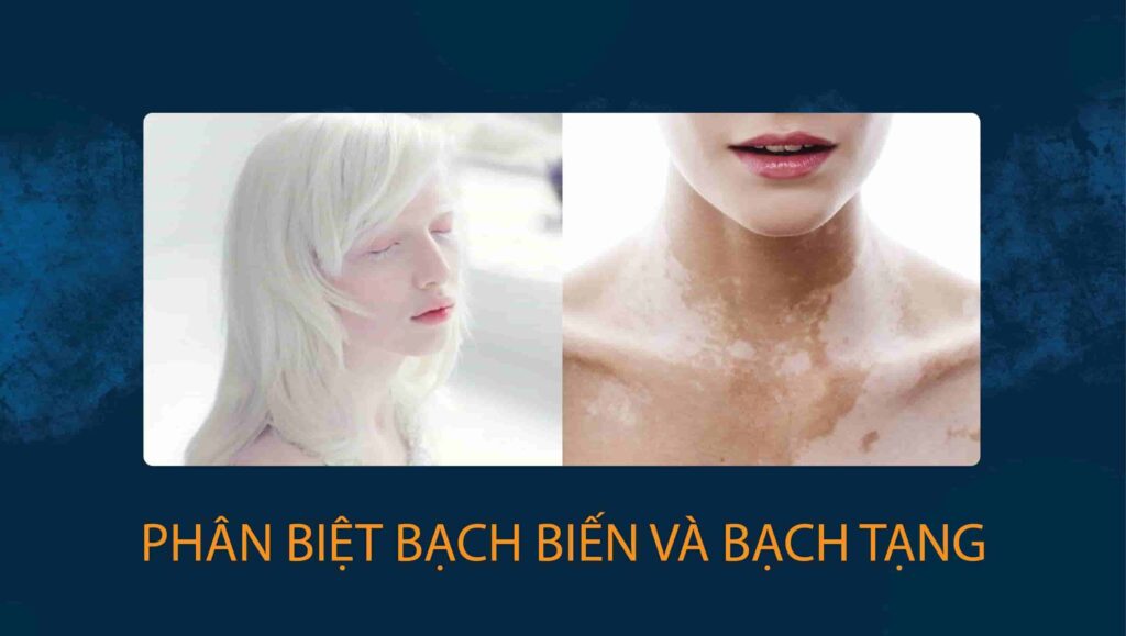 bạch biến và bạch tạng