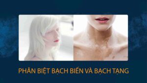 bạch biến và bạch tạng