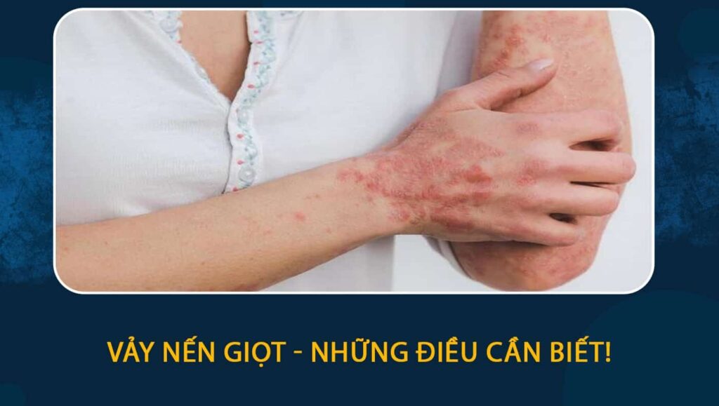 vảy nến giọt
