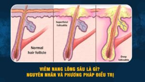 Viêm nang lông sâu
