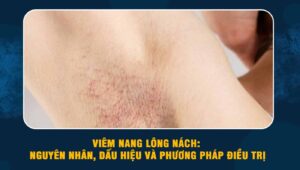 Viêm nang lông nách