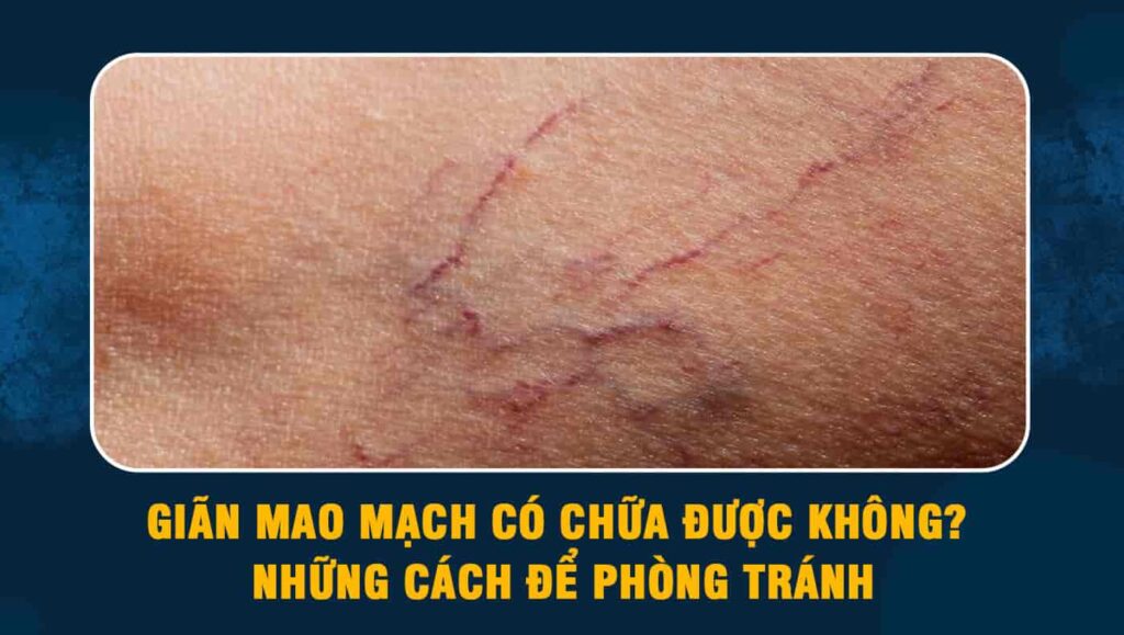 giãn mao mạch có chữa được không