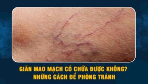 giãn mao mạch có chữa được không