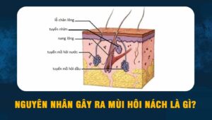 nguyên nhân gây ra mùi hôi nách
