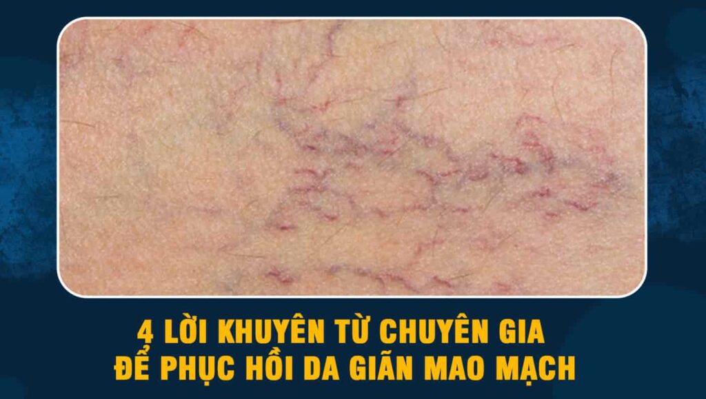 phục hồi da giãn mao mạch