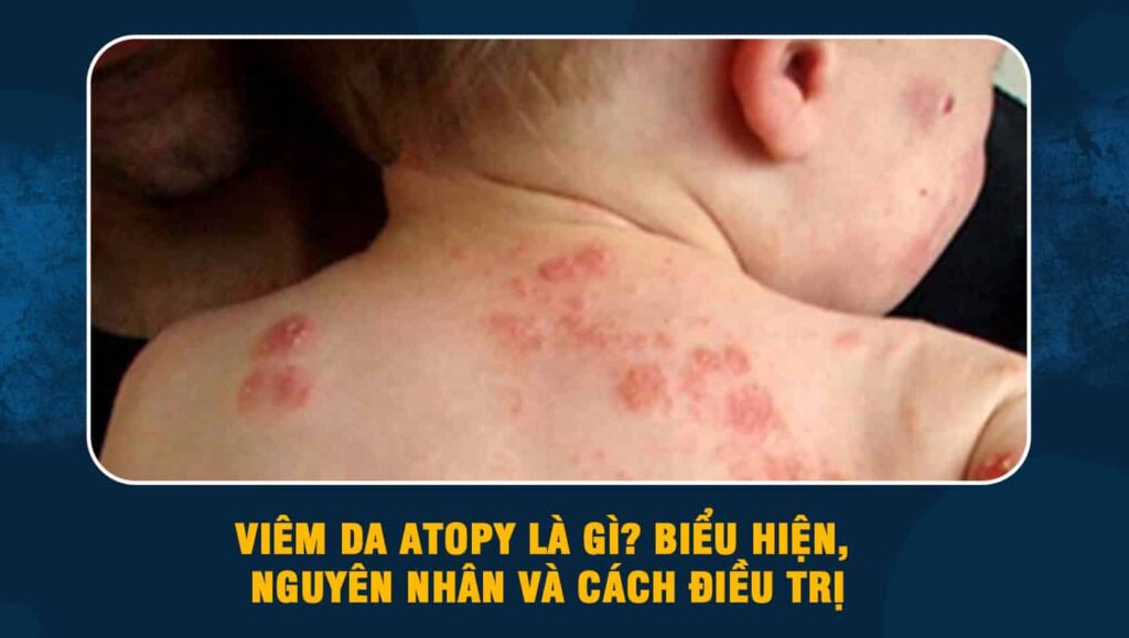 Viêm da atopy