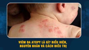 Viêm da atopy