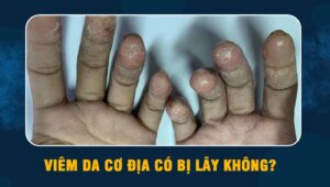 viêm da cơ địa có bị lây không
