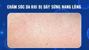 chăm sóc da bị dày sừng nang lông