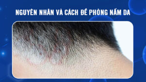 de-phong-nam-da