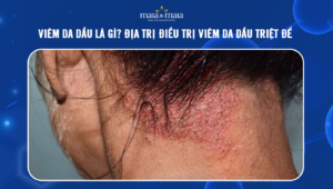 Viêm da dầu là gì? Địa trị điều trị viêm da dầu triệt để