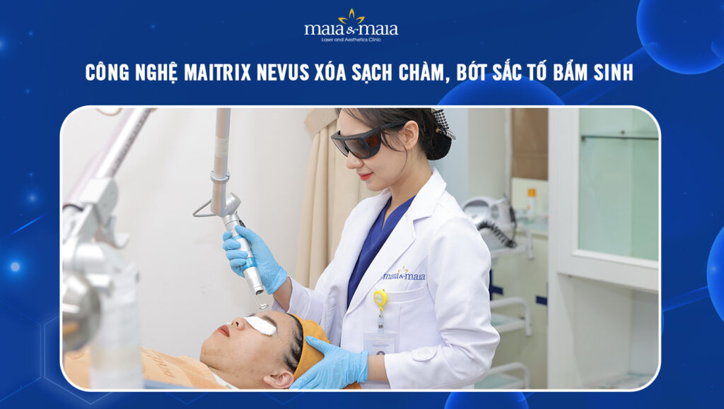 Công nghệ Maitrix Nevus điều trị xóa chàm, bớt sắc tố bẩm sinh