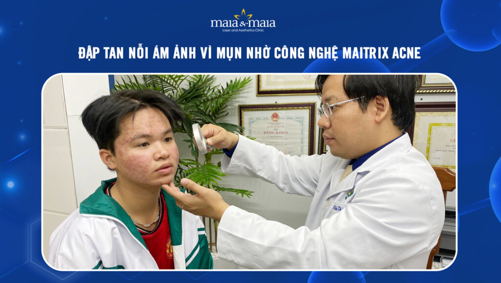 CÔNG NGHỆ MAITRIX ACNE ĐẬP TAN NỖI ÁM ẢNH VÌ MỤN 