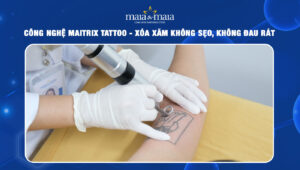 Công nghệ maitrix tattoo thum