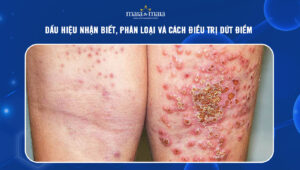 Viêm da: Dấu hiệu nhận biết, phân loại và cách điều trị dứt điểm