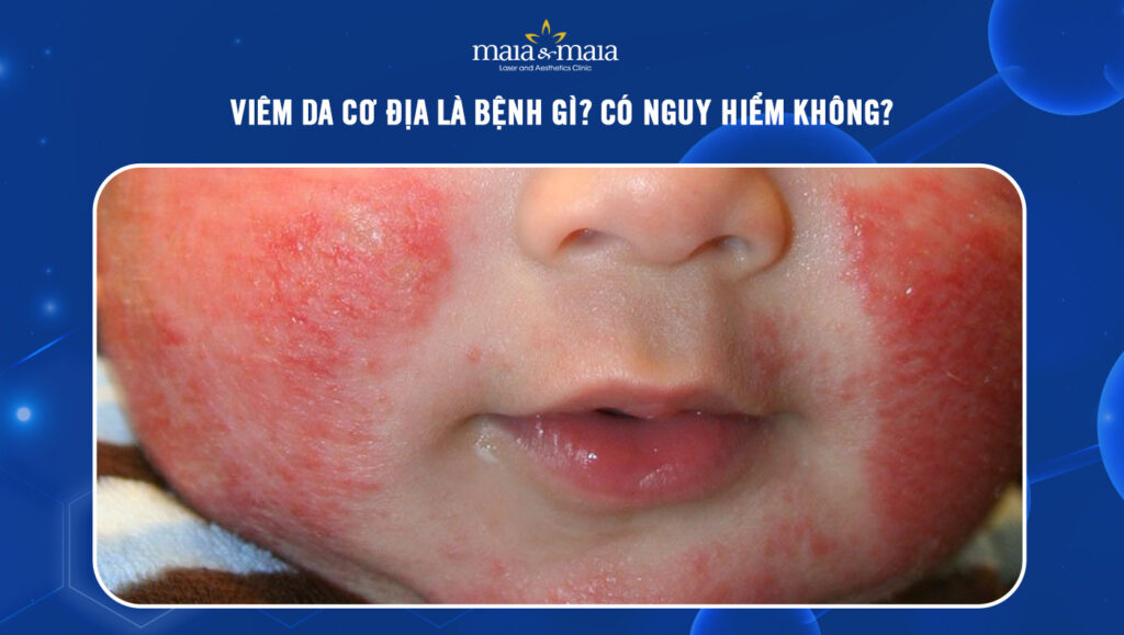 Viêm da cơ địa là bệnh gì? Có nguy hiểm không?