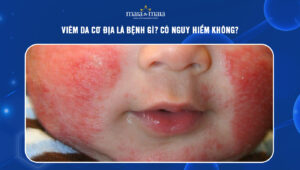 Viêm da cơ địa là bệnh gì? Có nguy hiểm không?