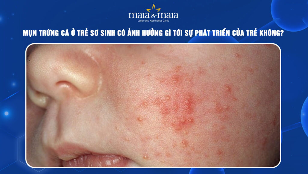 mụn trứng cá ở trẻ sơ sinh