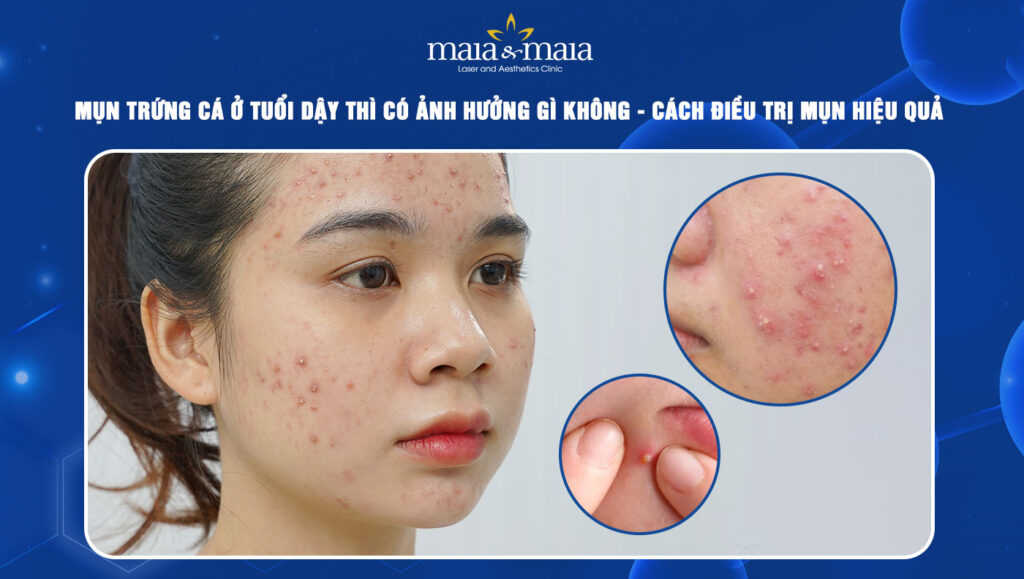 mụn trứng cá ở tuổi dậy thì thum