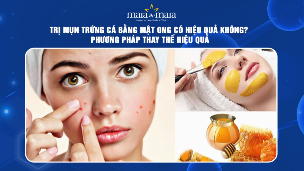trị mụn trứng cá bằng mật ong