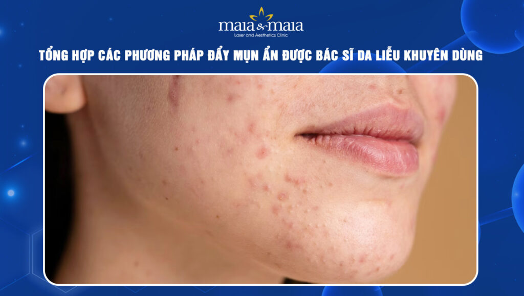 đẩy mụn ẩn