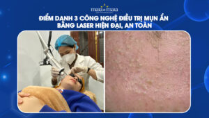 điều trị mụn ẩn bằng laser