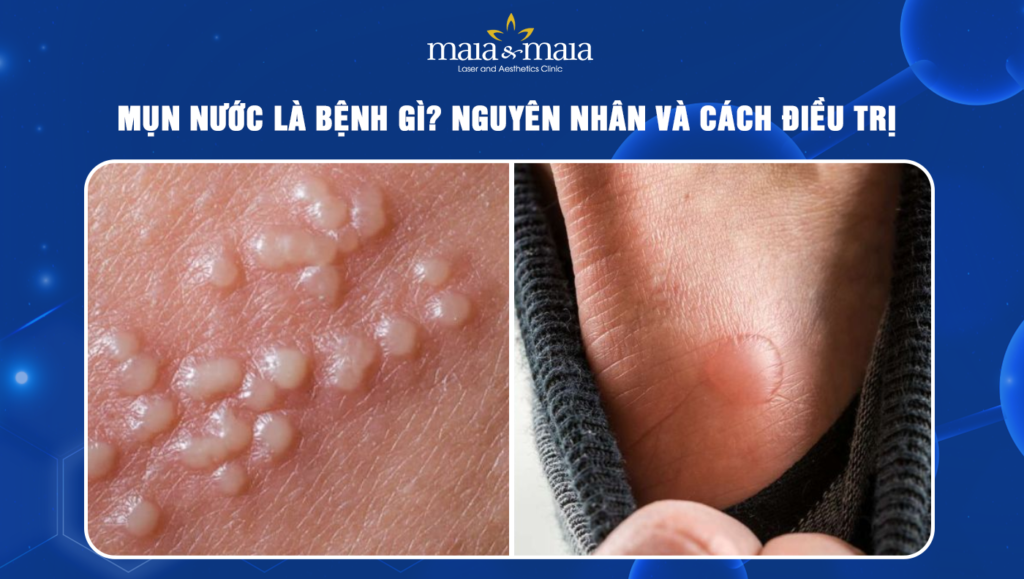 mụn nước