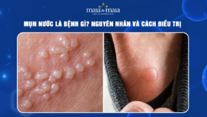 mụn nước