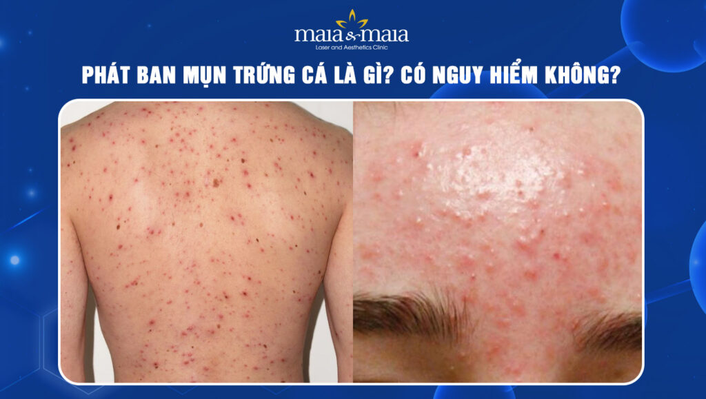 phát ban mụn trứng cá