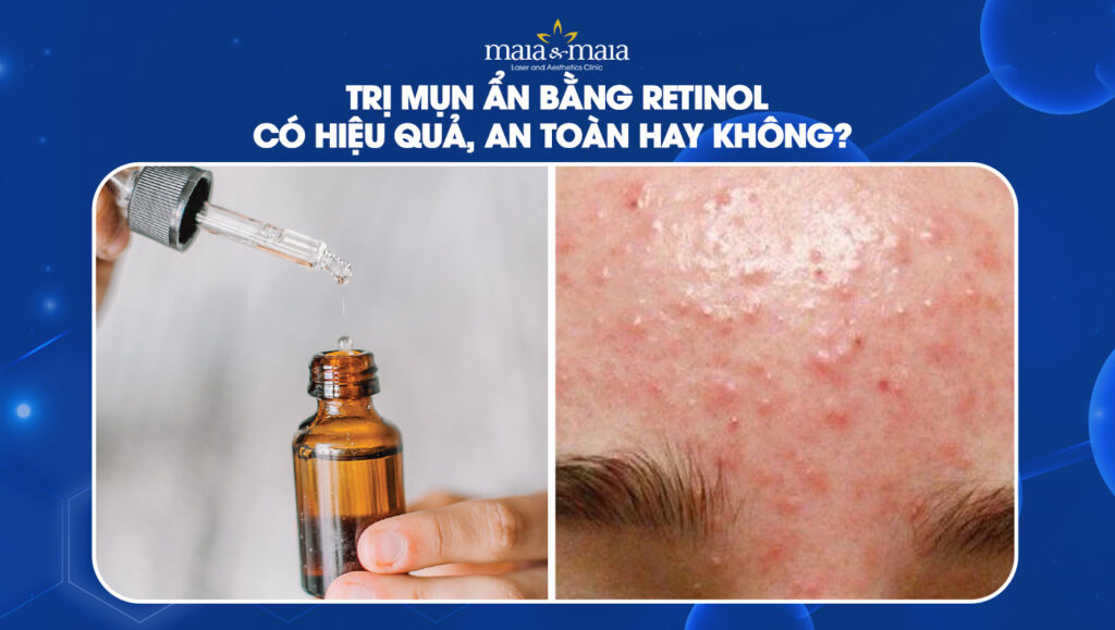trị mụn ẩn bằng retinol