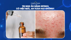 trị mụn ẩn bằng retinol