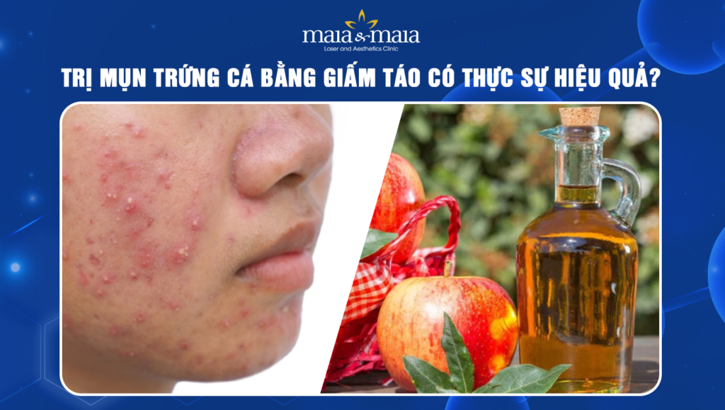 trị mụn trứng cá bằng giấm táo