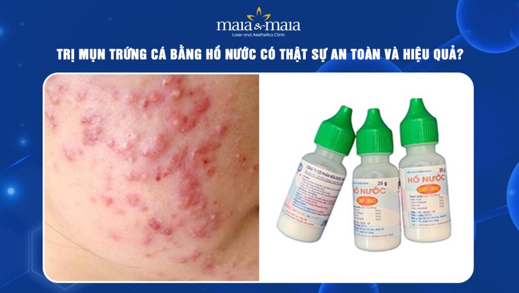 trị mụn trứng cá bằng hồ nước