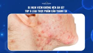 Bị mụn viêm không nên ăn gì