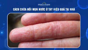 cách chữa nổi mụn nước ở tay
