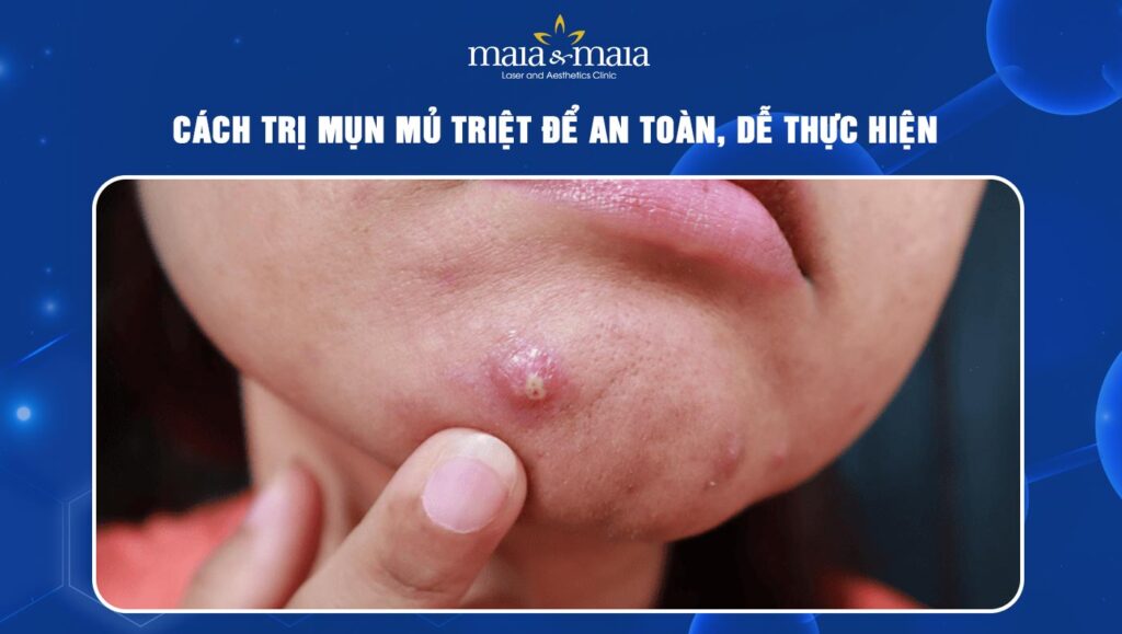 cách trị mụn mủ
