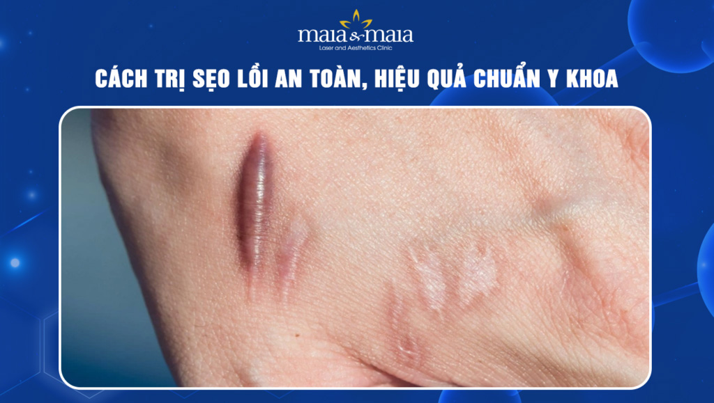 cách trị sẹo lồi