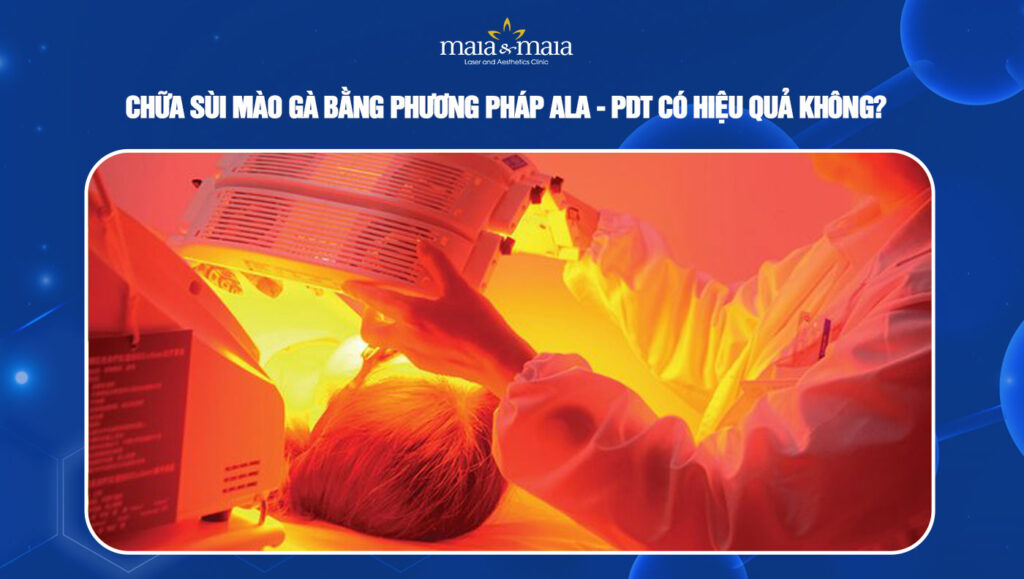 Chữa sùi mào gà bằng phương pháp ALA-PDT