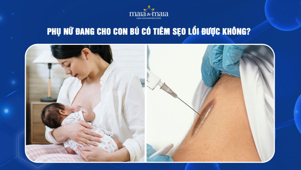 đang cho con bú có tiêm sẹo lồi được không