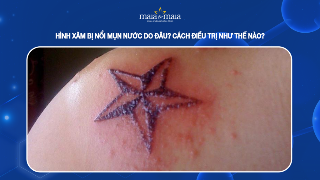hình xăm bị nổi mụn nước