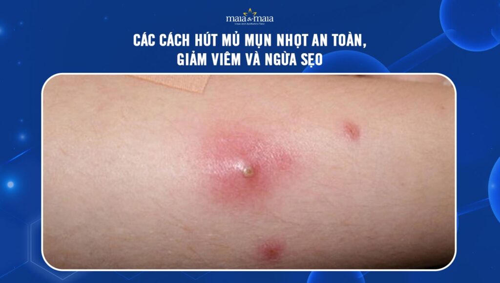 hút mủ mụn nhọt