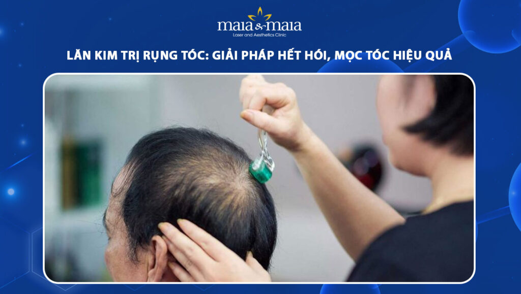 lăn kim trị rụng tóc