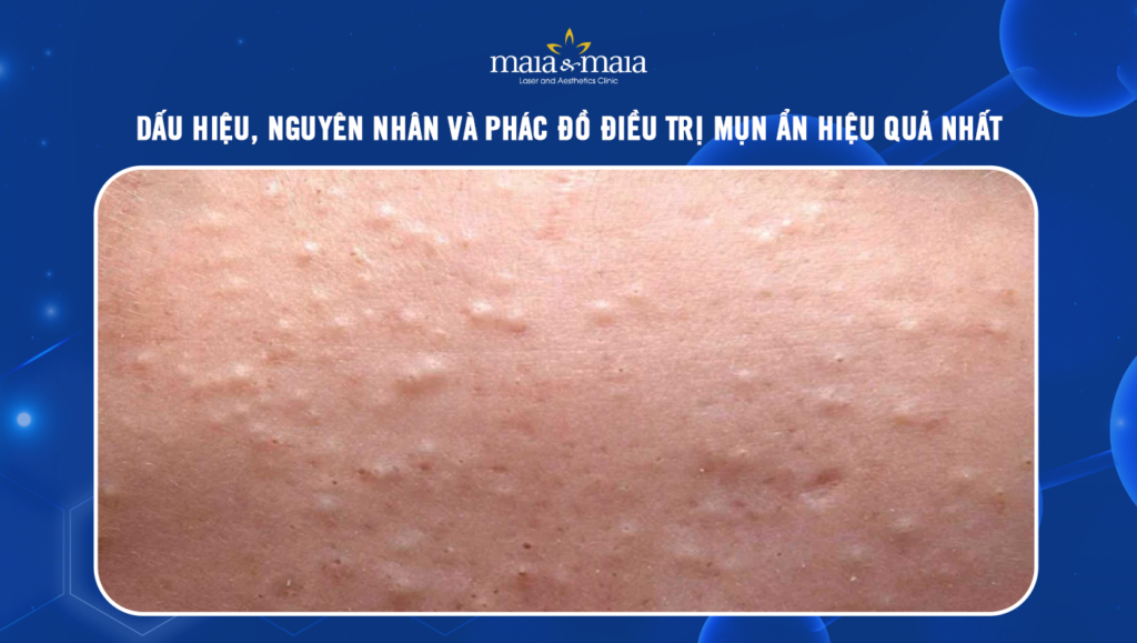 mụn ẩn