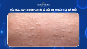 mụn ẩn