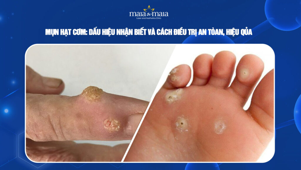 mụn hạt cơm