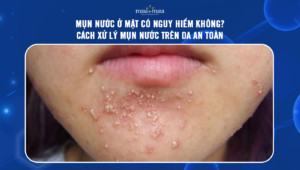 mụn nước ở mặt